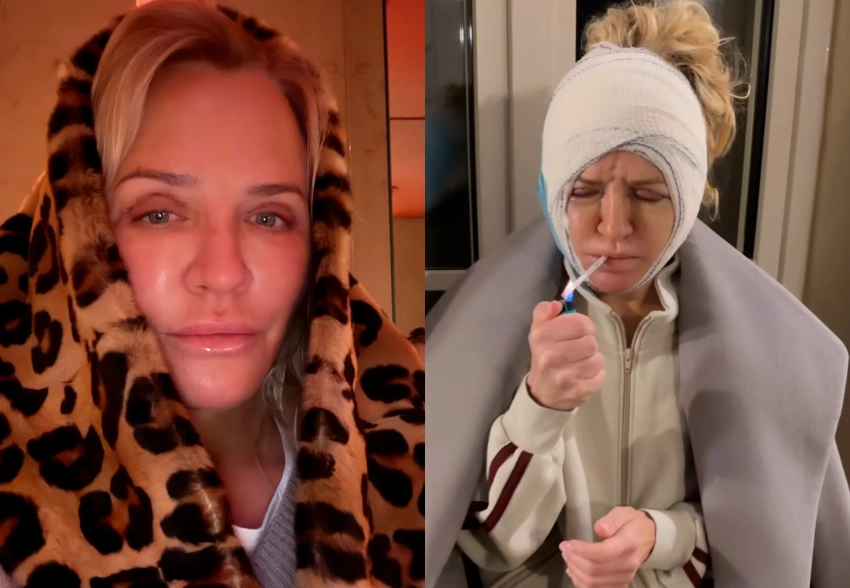 Виктория Шелягова показала, как восстанавливается после пластической операции на лице